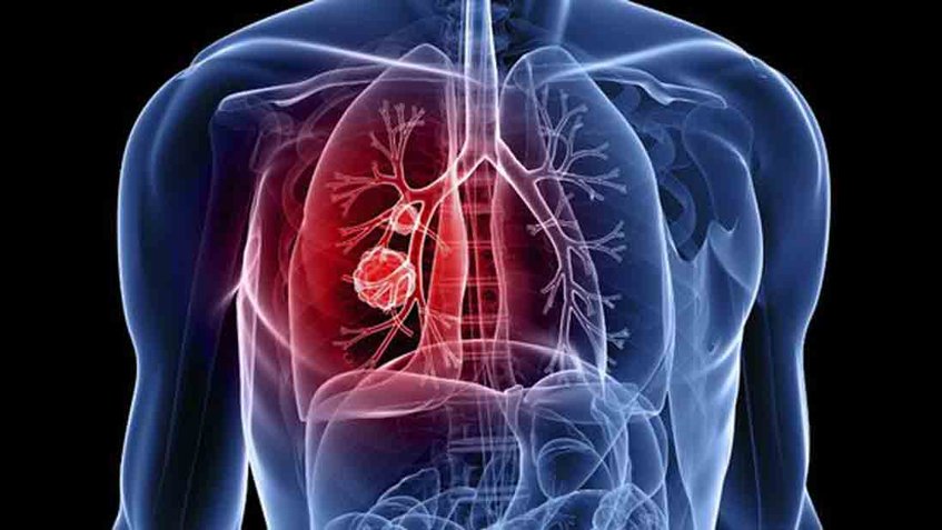  Estudiantes del IPN desarrollan sistema para detectar cáncer de pulmón