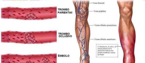  Trombosis, un padecimiento que se puede prevenir: SESA