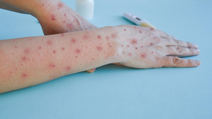  SESA brinda recomendaciones para evitar el contagio de la viruela símica